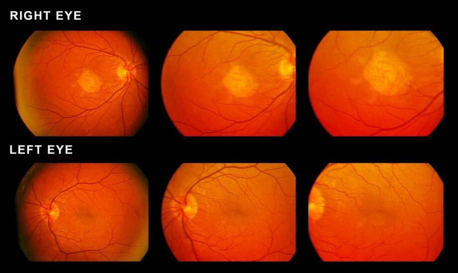 Badanie oka dna a diagnoza zwyrodnienia żółtej plamki