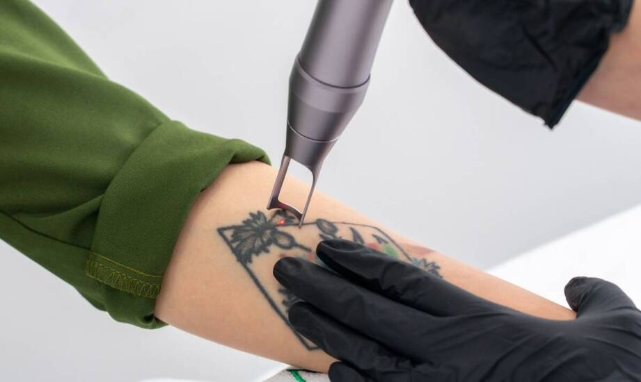 Jakie są koszty związane z profesjonalnym usuwaniem tatuażu laserowym?