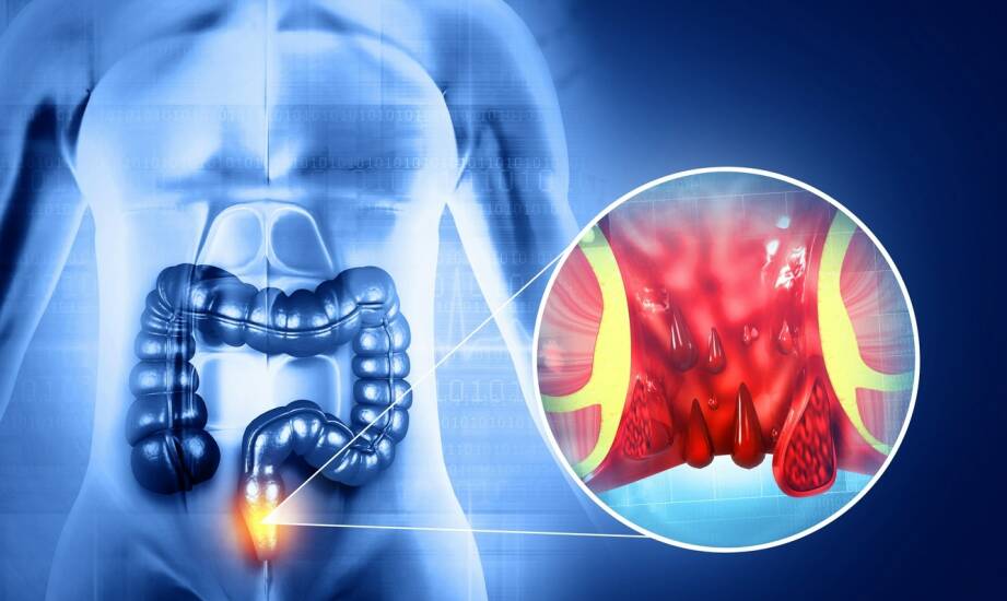 Proktologia: najczęstsze dolegliwości i sposoby diagnozy krok po kroku