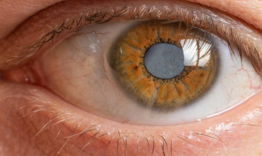 Retinopatia cukrzycowa: objawy, badania i wczesna diagnostyka wzroku