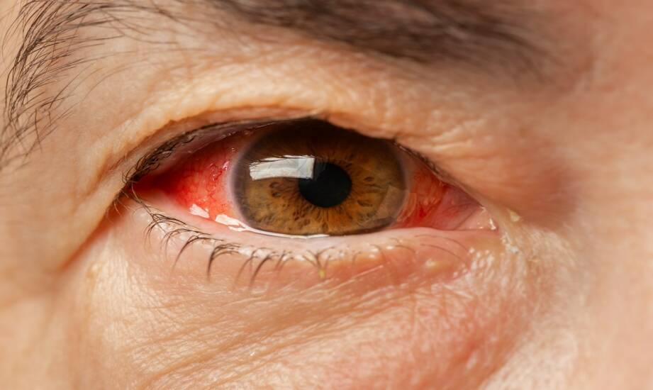 Retinopatia cukrzycowa: objawy, przyczyny i sposoby wczesnego wykrywania