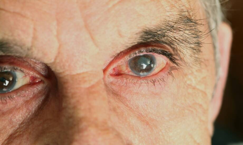 Retinopatia cukrzycowa — objawy, przyczyny i sposoby wczesnego wykrywania