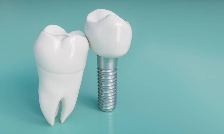 Implant tytanowy czy cyrkonowy — kiedy wybór materiału wpływa na gojenie i estetykę