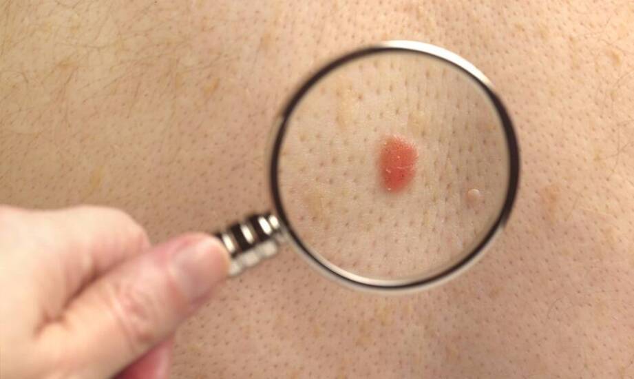 Niepokojąca zmiana skórna — jak przebiega pierwsza ocena i kiedy potrzebna jest dalsza diagnostyka