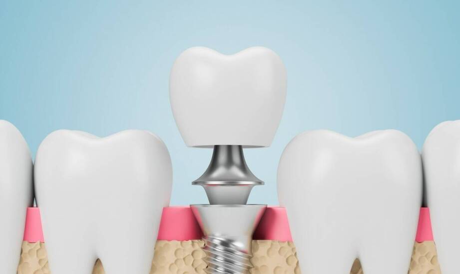 Jak przebiega kwalifikacja do implantu i co warunkuje jego integrację z kością
