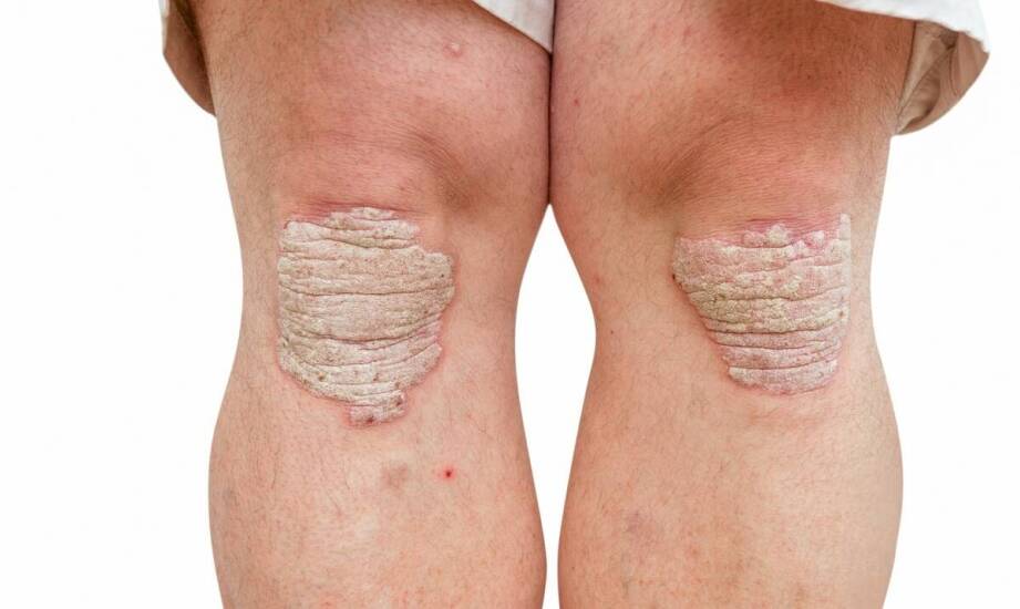 Jak dermatolog rozróżnia łuszczycę, trądzik i AZS podczas pierwszej konsultacji