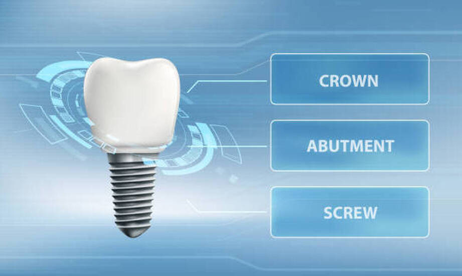 Od czego zależy koszt etykiet UDI na opakowaniach implantów dentystycznych