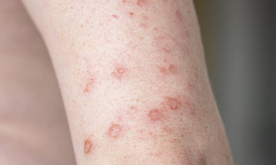 Nawracające zmiany skórne, świąd i łuszczenie — kiedy potrzebna jest ocena dermatologa