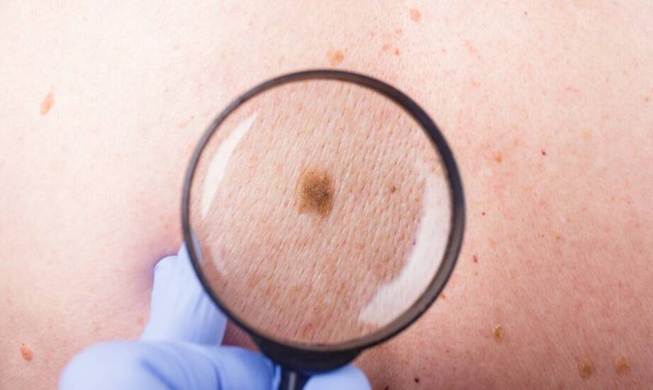 Znamię barwnikowe u dziecka — kiedy wymaga oceny dermatoskopowej, a kiedy tylko obserwacji