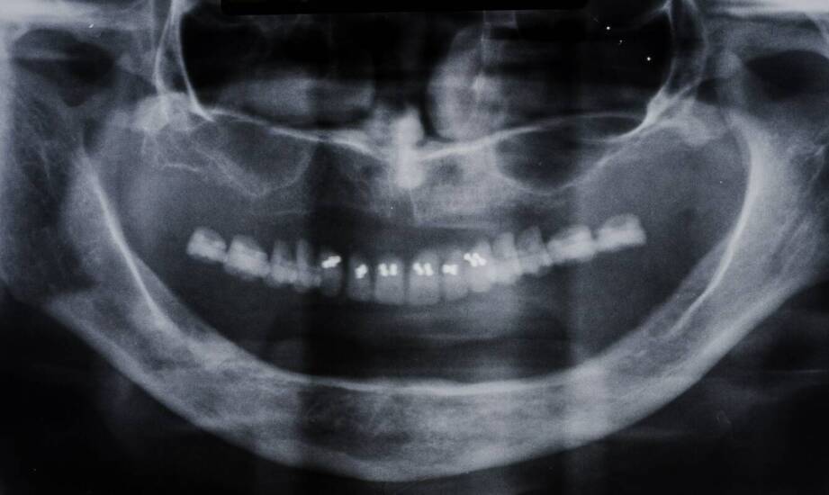 Pierwsza konsultacja przed implantami — co lekarz ocenia, zanim zaplanuje leczenie