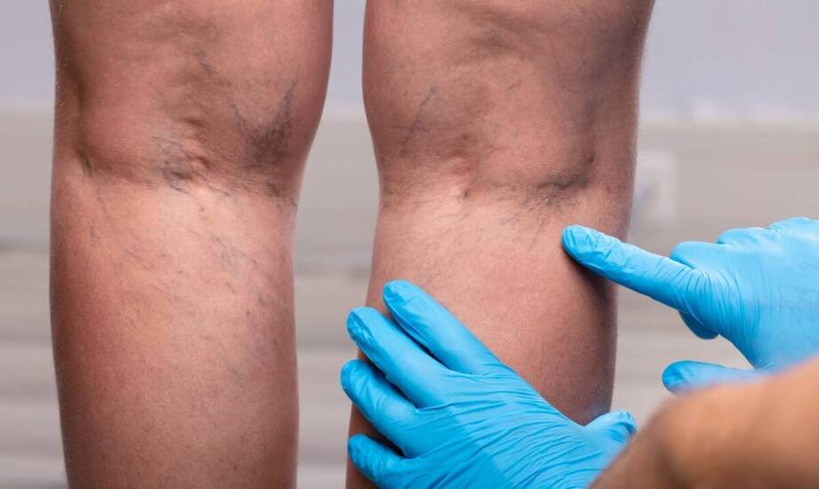 Laser, skleroterapia czy fale radiowe — jak dobrać metodę do obrazu żylaków nóg i rekonwalescencji