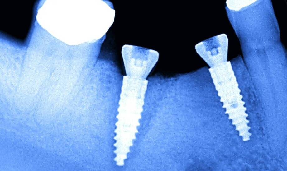 Jak tomografia i wywiad medyczny kwalifikują do odbudowy zębów na implantach tego samego dnia