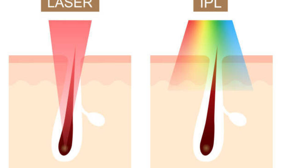 Dlaczego laser aleksandrytowy i neodymowo-yagowy działają inaczej na różne typy skóry
