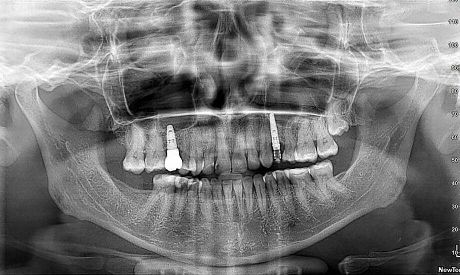 Co decyduje o kwalifikacji do implantu i późniejszej odbudowy zęba