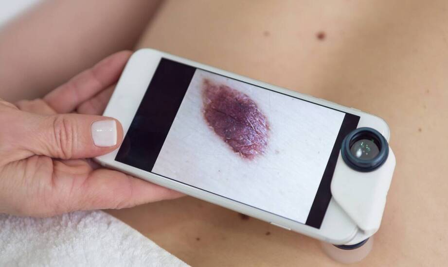 Czego lekarz ocenia w znamionach podczas dermatoskopii i jak przygotować skórę do badania