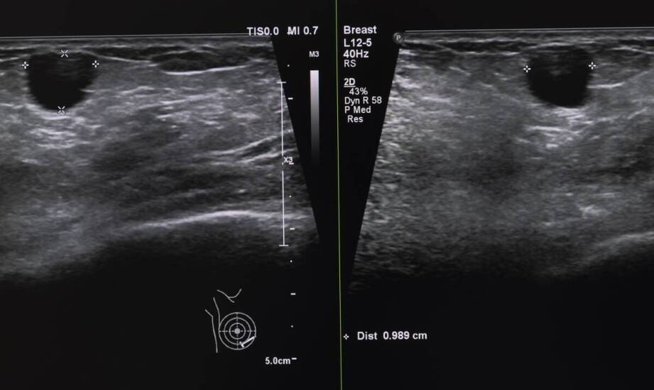 Kiedy ultrasonografia piersi pomaga wyjaśnić niepokojący objaw i co pokazuje