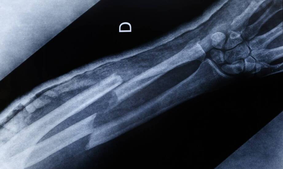 Badanie nadgarstka po urazie — kiedy ultrasonografia coś wyjaśnia