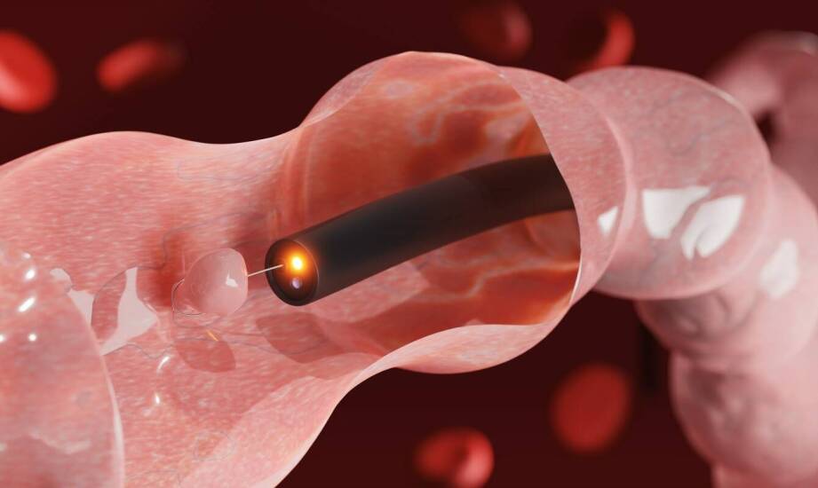 Kiedy angioplastyka tętnic kończyn może zastąpić operację otwartą