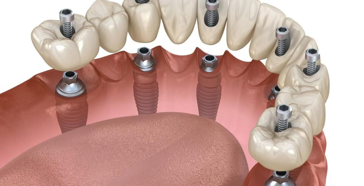 Kiedy odbudowa kości w szczęce górnej staje się warunkiem wszczepienia implantu