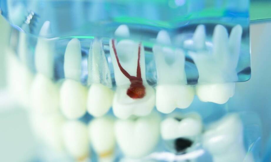 Jak materiały używane w endodoncji wpływają na szczelność i trwałość leczenia kanałowego