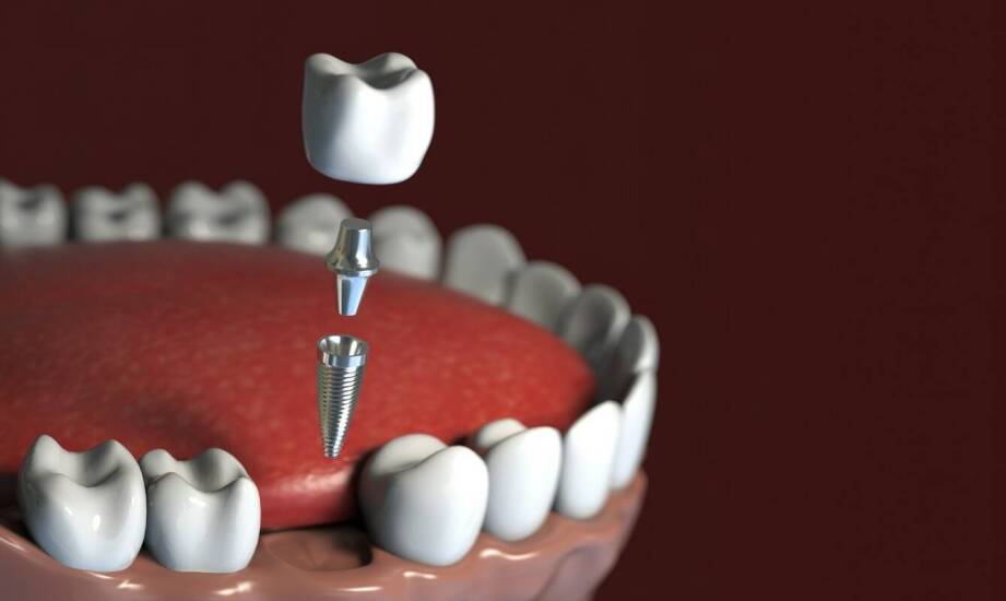Pierwsze miesiące po wszczepieniu implantu — jak dieta i higiena wpływają na gojenie?