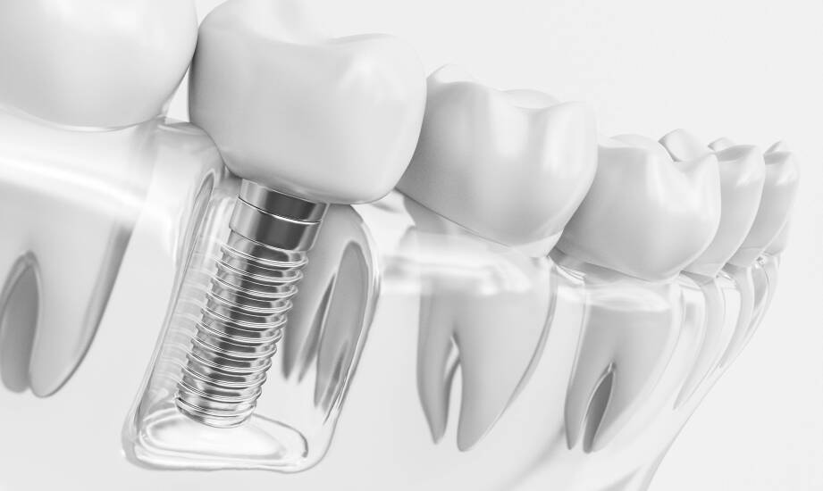 Kiedy odbudowa dna zatoki staje się warunkiem stabilnego wszczepienia implantu