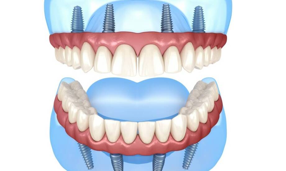 Odbudowa całego łuku na sześciu implantach — kto ją rozważa i jak przebiega gojenie
