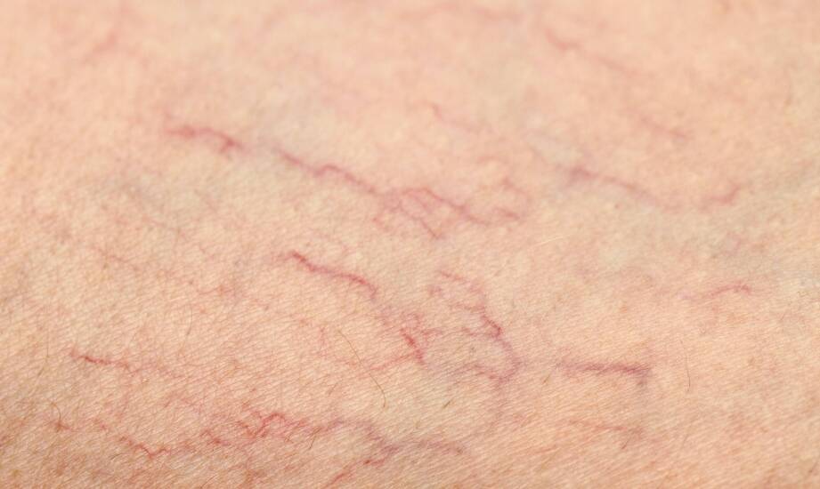 Laser na pajączki — jak przygotować skórę i czego oczekiwać po zabiegu