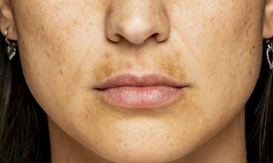 Plamy posłoneczne, melasma i ślady po stanie zapalnym — co je różni przed laserem