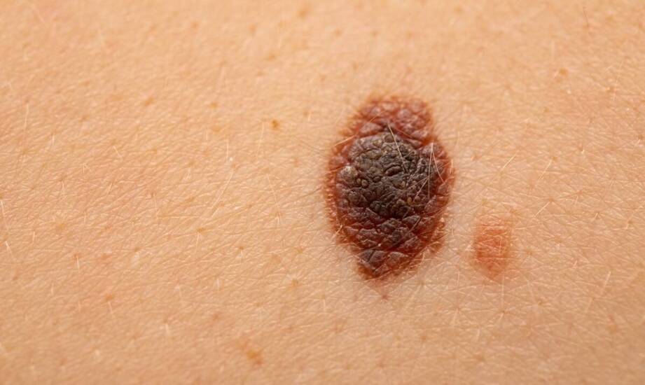 ABCDE znamienia i dermatoskopia — kiedy zmiana skórna powinna trafić do chirurga