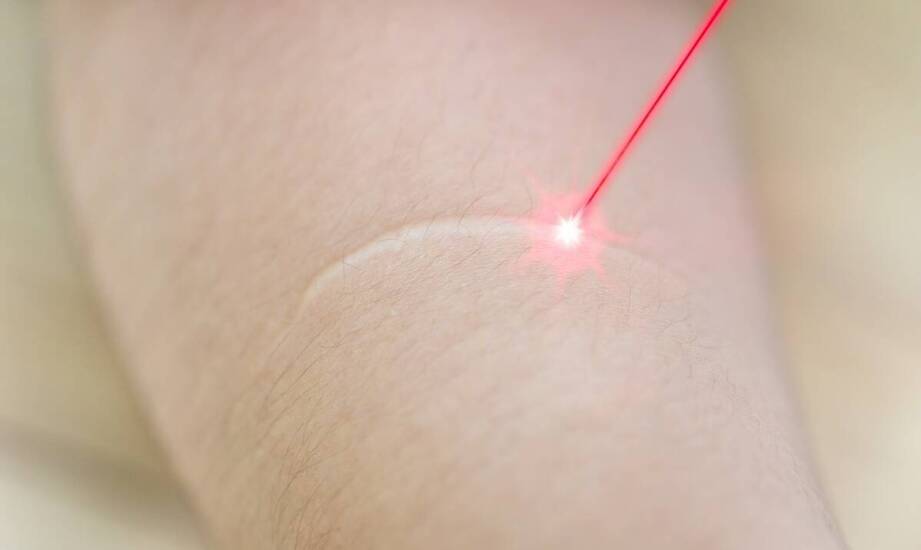 Co dzieje się z naczynkiem po zabiegu laserowym i jak goi się skóra