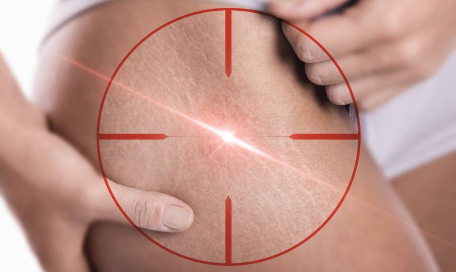 Jak dobrać laseroterapię do przebarwień, blizn i oznak starzenia skóry po 30. roku życia