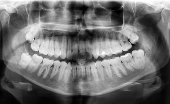 Co dentysta widzi na panoramie zębów i kiedy potrzebuje dokładniejszego obrazu