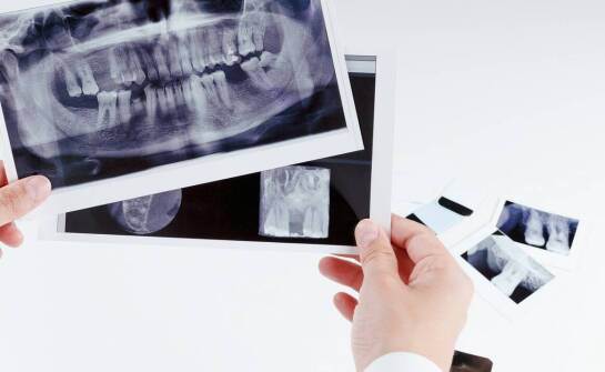 Zdjęcie rtg zęba a diagnostyka problemów z korzeniami – co warto wiedzieć?