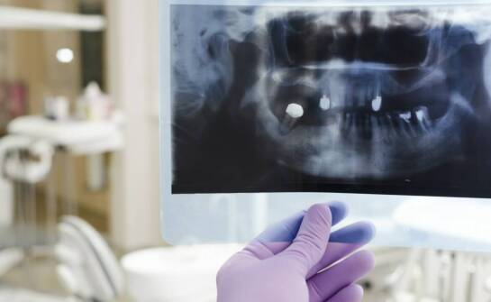 Rola diagnostyki RTG przed i po leczeniu endodontycznym