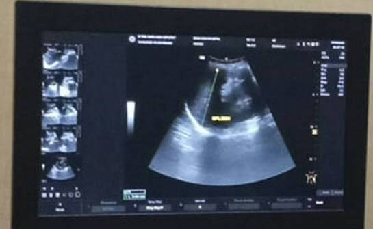 Zastosowanie ultrasonografii w diagnostyce chorób jąder