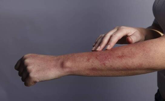 Jakie terapie oferuje dermatolog dla pacjentów z egzemą?