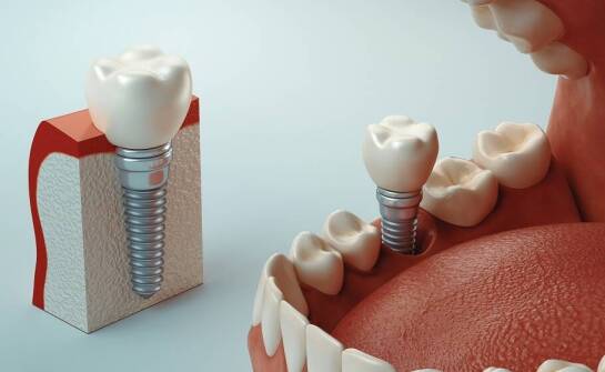 Czy każdy pacjent może skorzystać z zabiegu wszczepienia implantów zębowych?