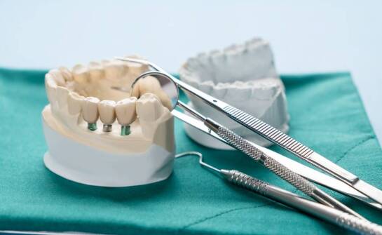 Proces zakładania implantów zębów – co warto wiedzieć przed zabiegiem?