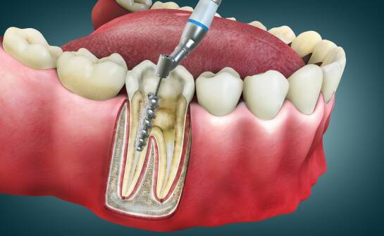 Jakie są najczęstsze mity dotyczące endodoncji i jak się z nimi rozprawić?
