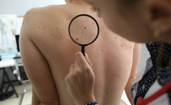Znaczenie regularnych kontroli znamion u dermatologa