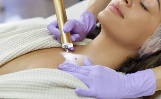 Jak skutecznie pozbyć się włókniaków?