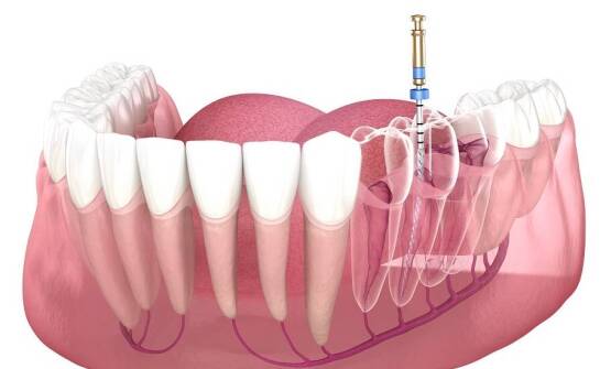 Jak dentysta dobiera odpowiednie leczenie endodontyczne?