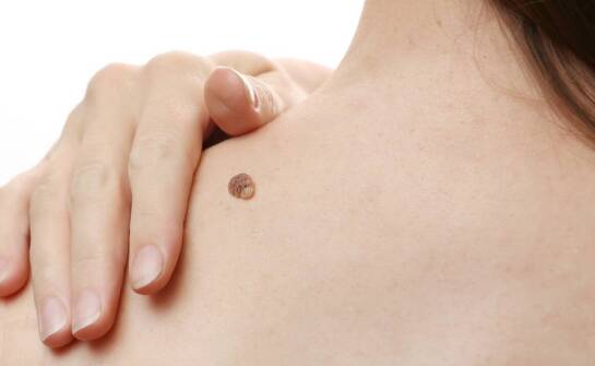 Czy brodawki na powiece mogą wskazywać na inne schorzenia?