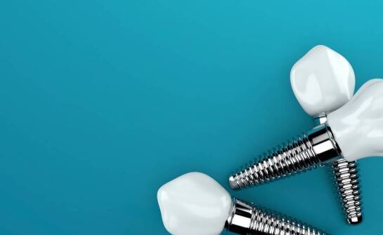 Jakie są etapy zakładania implantów stomatologicznych?