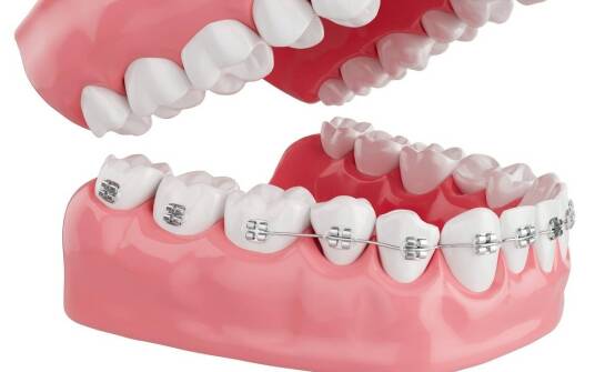 Jakie są długoterminowe efekty stosowania aparatów samoligaturujących?