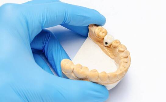 Jakie są różnice między mostami a implantami w protetyce zębowej?