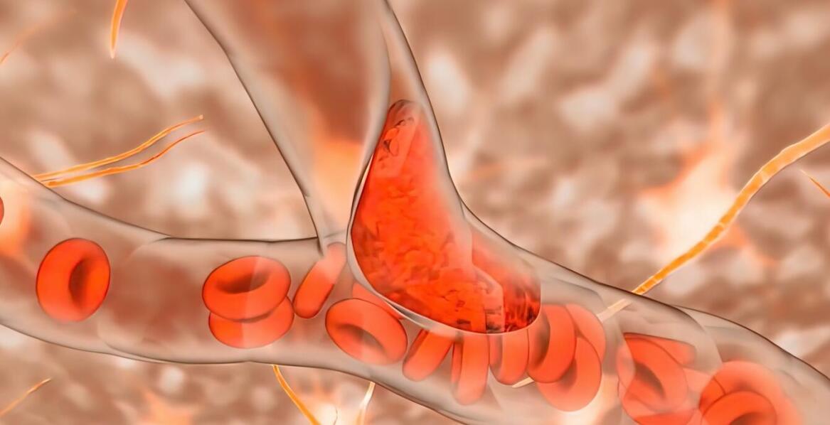 Jakie są alternatywy dla tradycyjnych leków na żylaki kończyn dolnych?