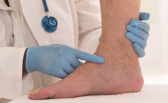 Efektywność skleroterapii w redukcji pajączków naczyniowych – co warto wiedzieć?