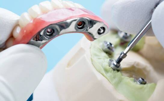 Implanty a zdrowie jamy ustnej – jakie są długoterminowe korzyści?